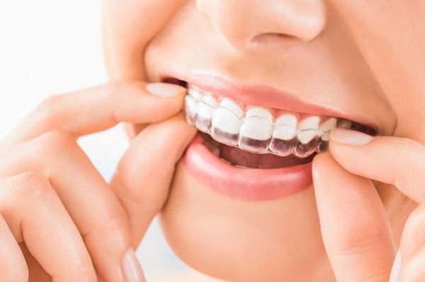 The Difference Between Invisible Braces and Traditional Braces
